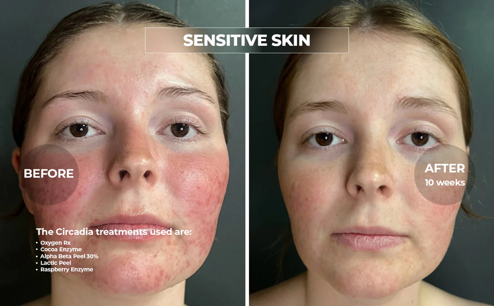 Rosacea Oxygen Treatment Facial