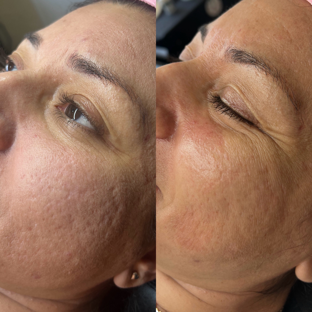 Skin Needling (Micro needling)