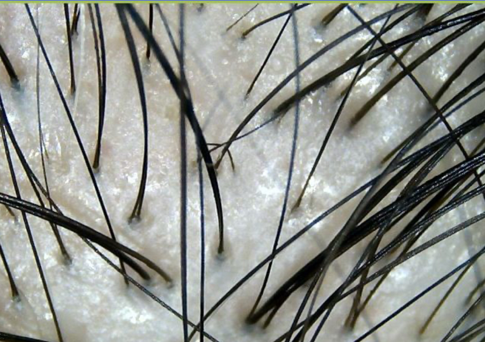 FOLLICLULAR RESTORATIVE PROTOCOL