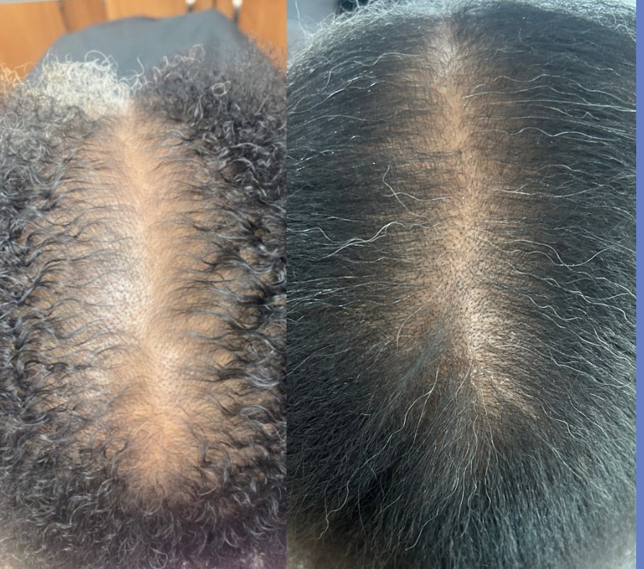 FOLLICLULAR RESTORATIVE PROTOCOL