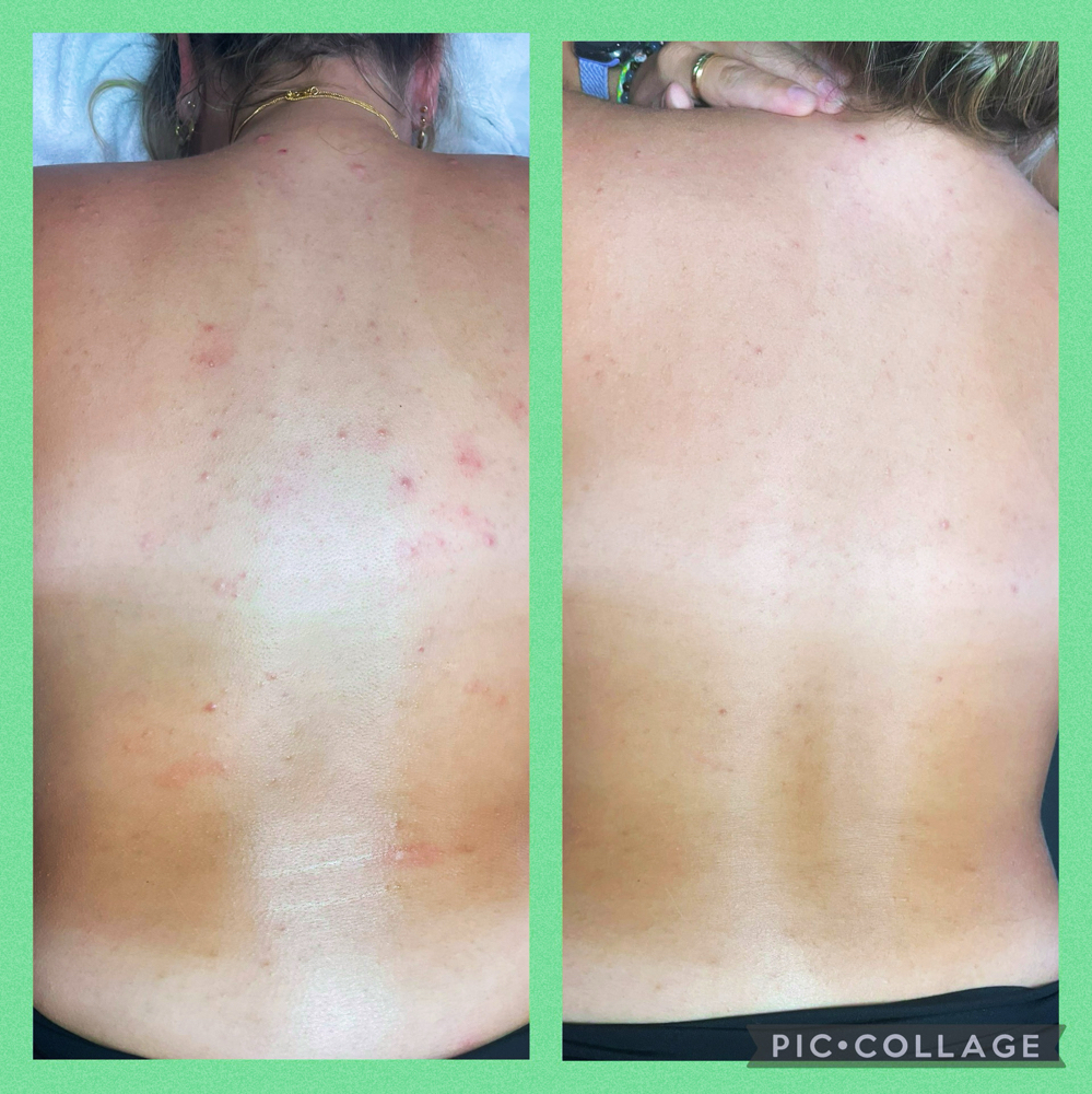 Back Facial