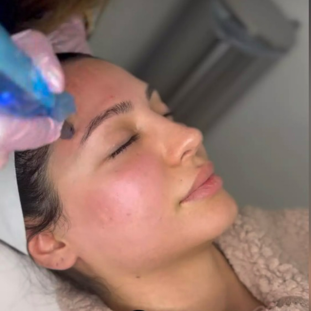 Microneedling maintenance returning at Skin Theory Collective in Grand  Terrace, CA