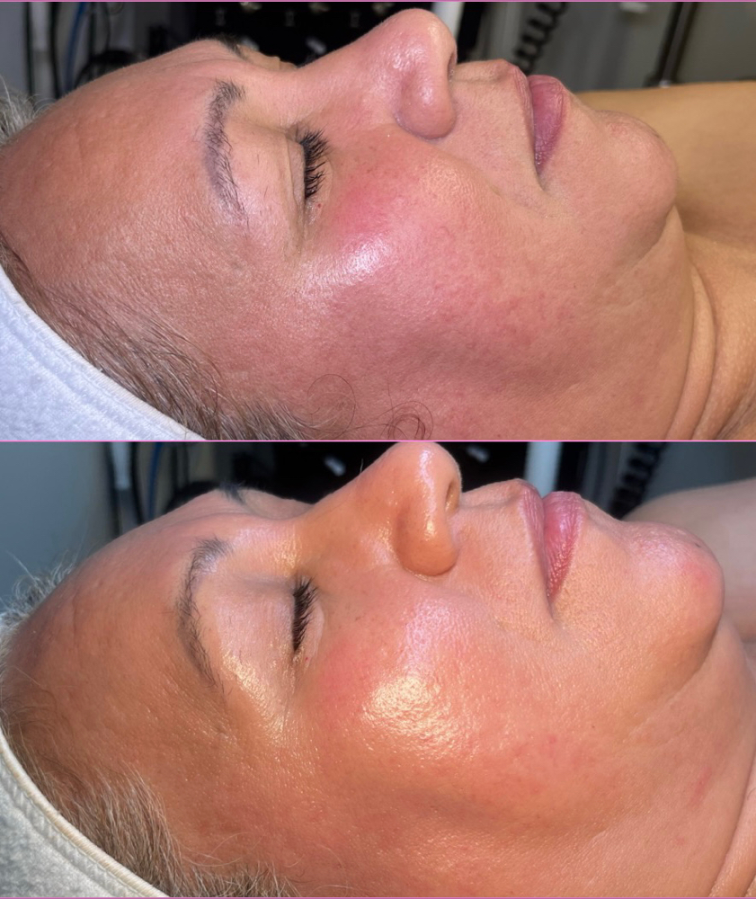 Mini Facial w/Dermaplane