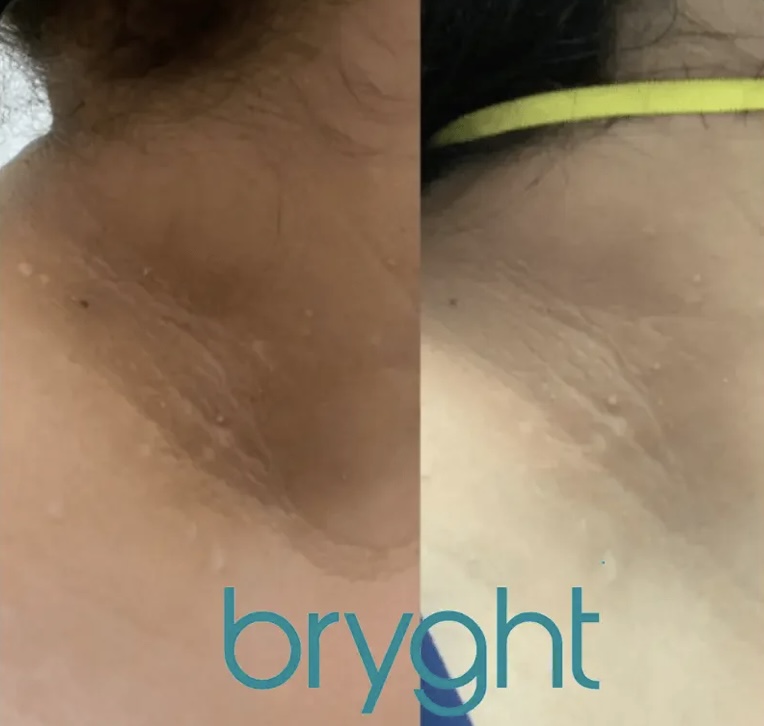 Intimate Bleaching- Neck
