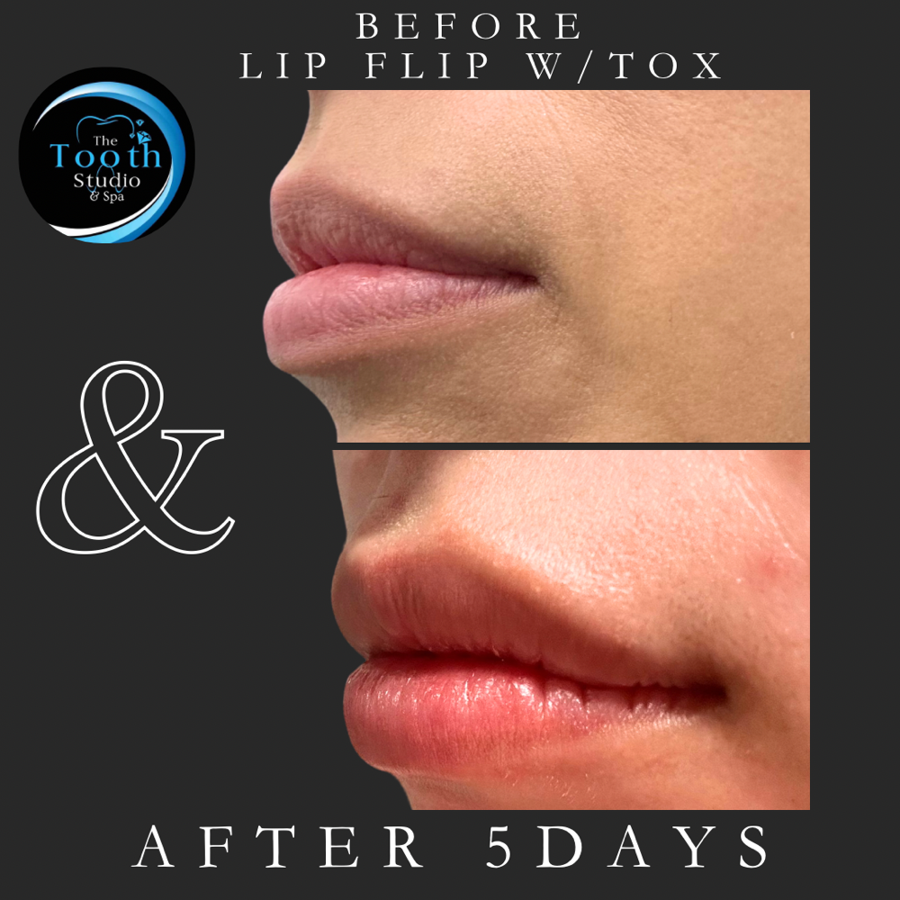 Lip Flip W Tox
