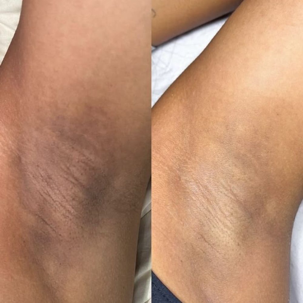 Underarm Brightening Treatment at Beauty & Skin by Tristin in Russellville, KY