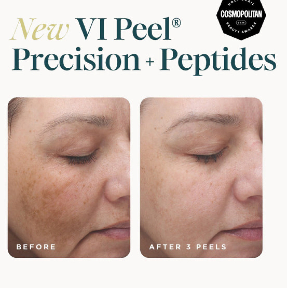 Chemical Peel Treatment at Stony Point Spa in Watertown, SD