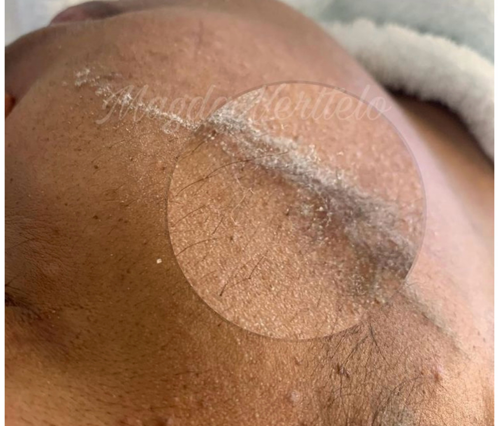 Dermaplane at Liz_Skin_Beauty in Joliet, IL