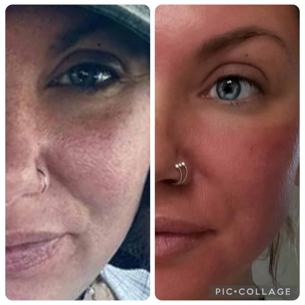 Microneedle at RAE Aesthetics in Hudson, OH