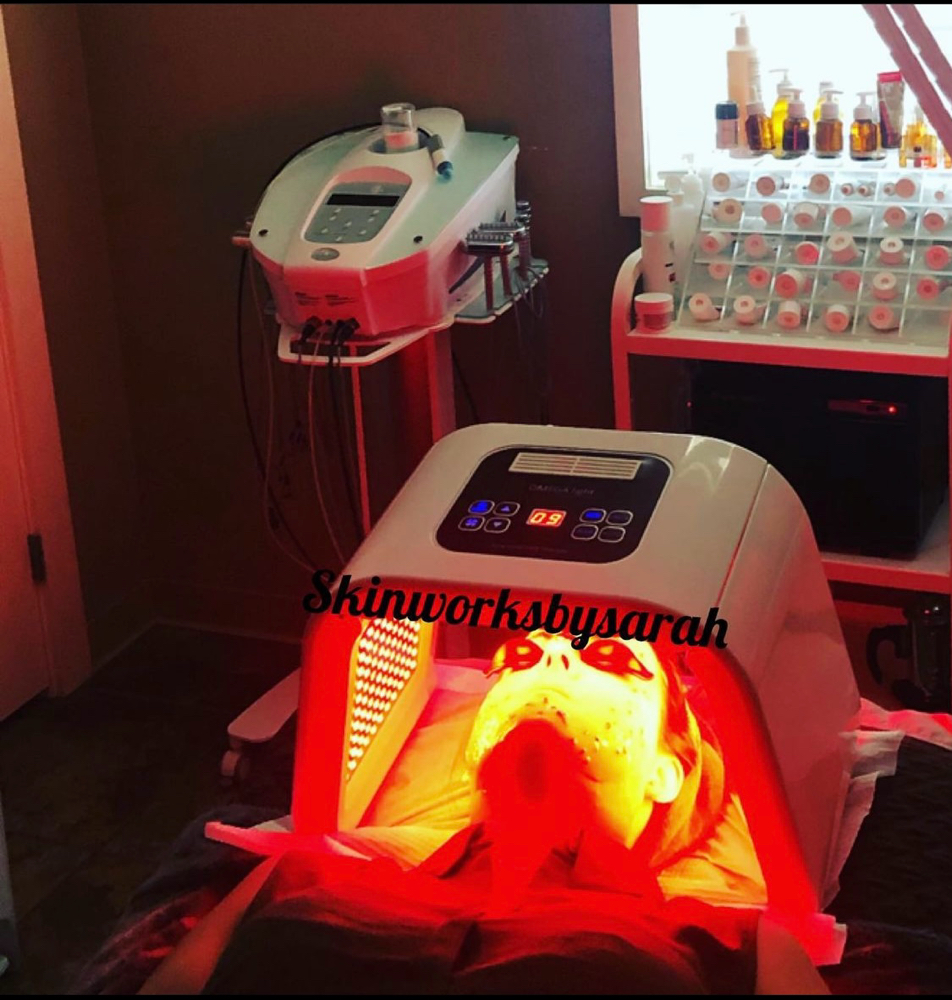Microneedling Facial