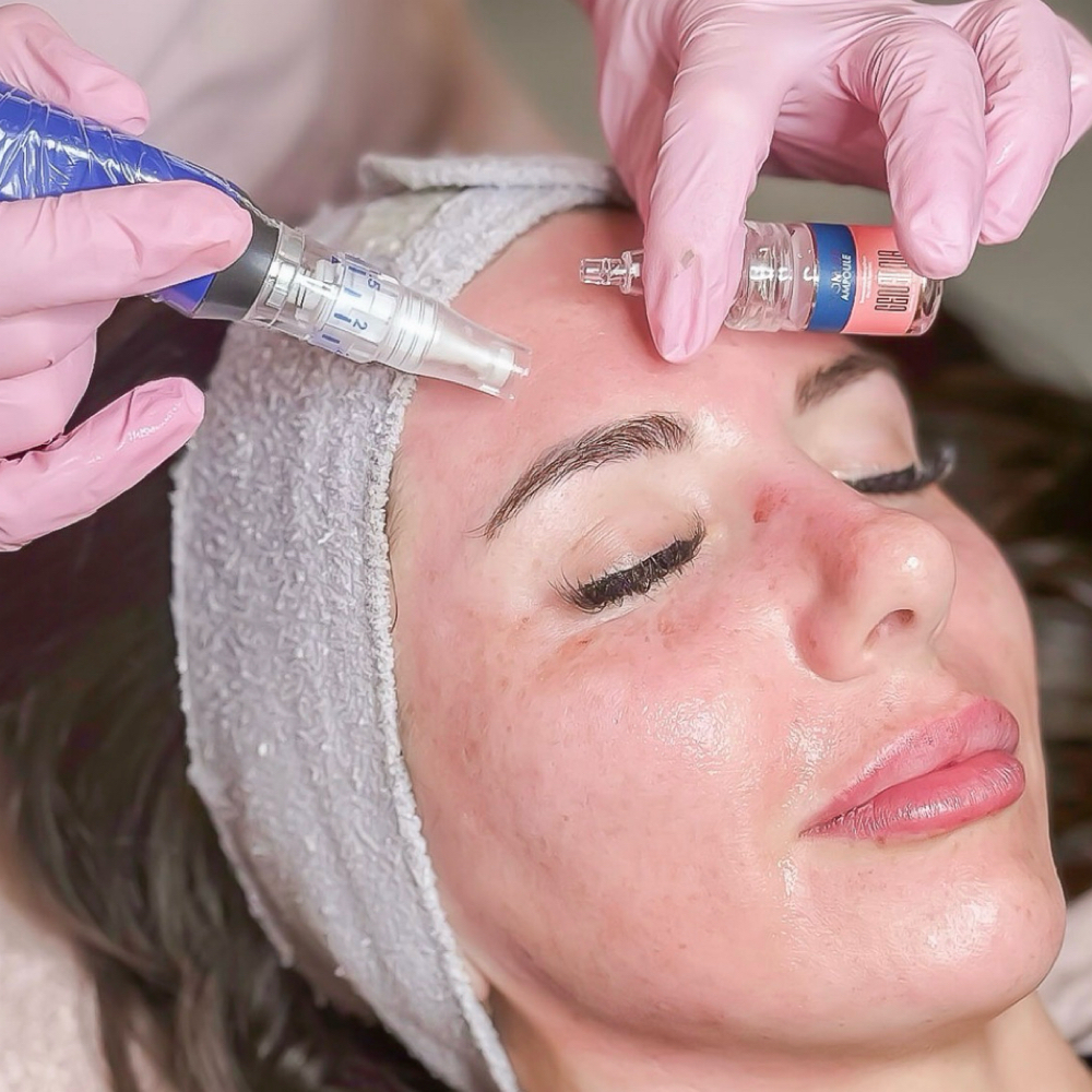 Microneedling at Beauty Fox Beauty Room in Annapolis, MD