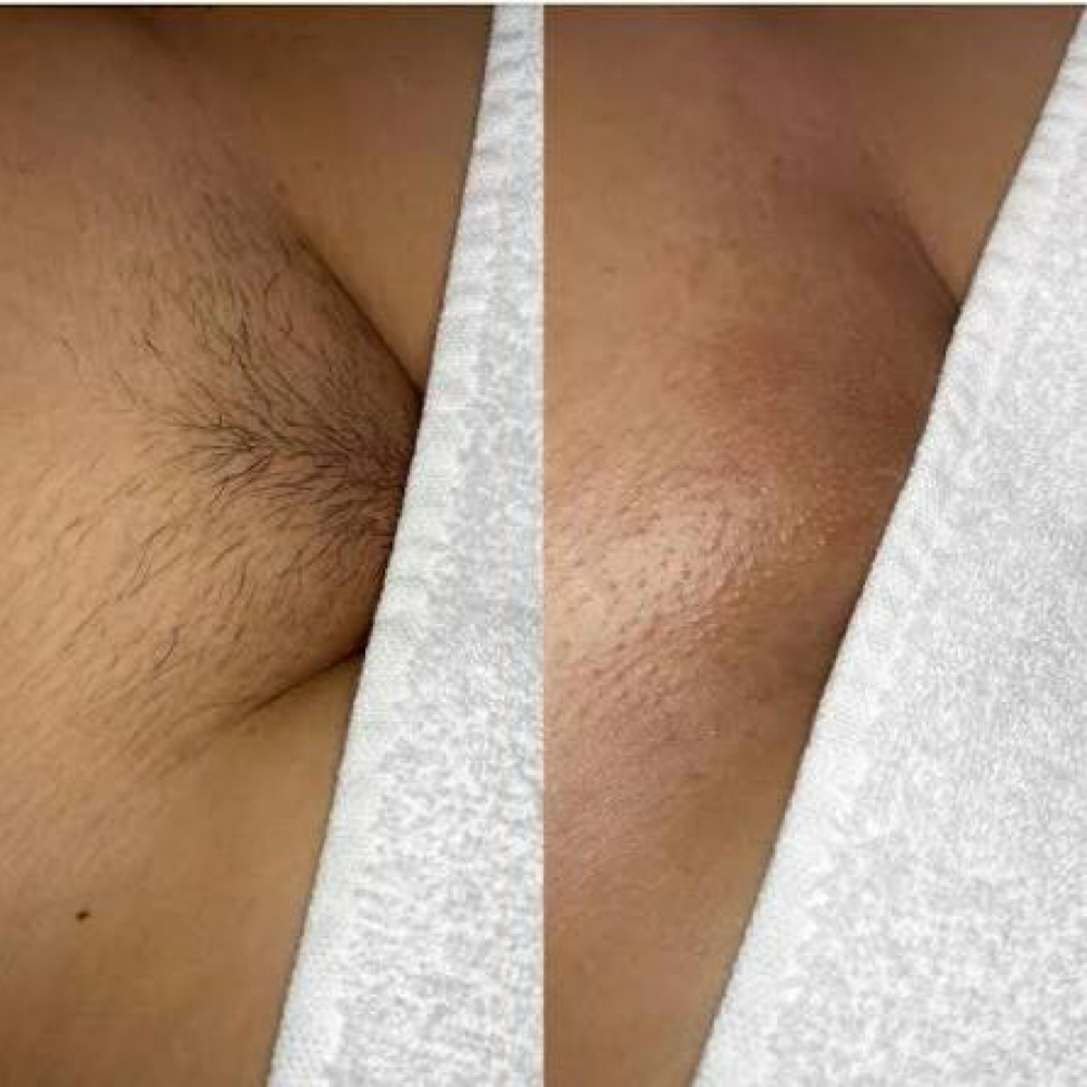 Brazilian Wax at WaxLand & BodySculpting in Los Angeles, CA