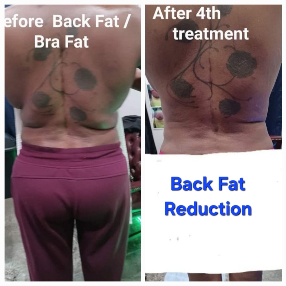 4 Sessions🔥 Back Fat Reduction wit at JUST BEAUTIFUL SKIN in Goose Creek, SC