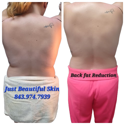 Back FAT REDUCTION