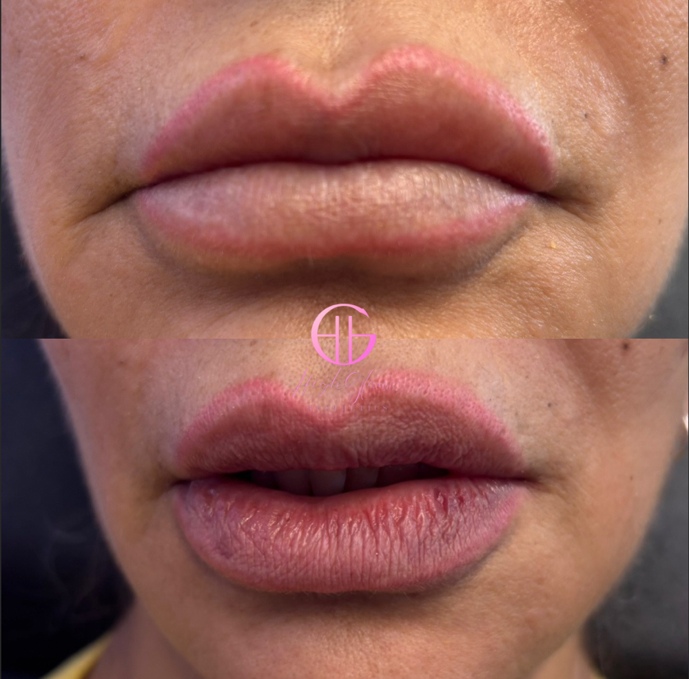Lip Filler Dissolve Model Price