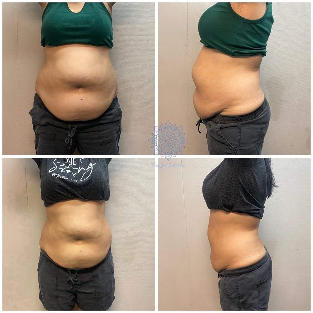 Right & Tight Tummy- 3 Services