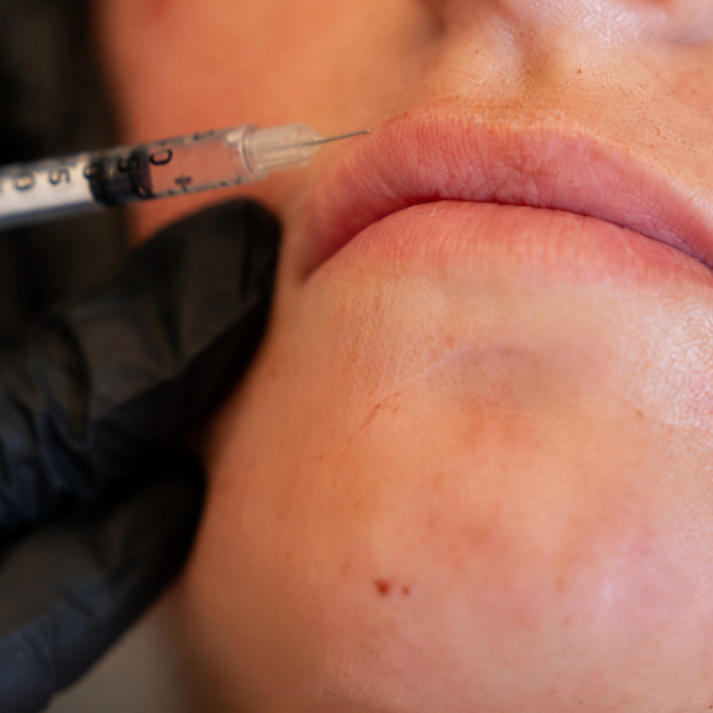 Lip Flip at KB Aesthetics PLLC in Brighton, MI