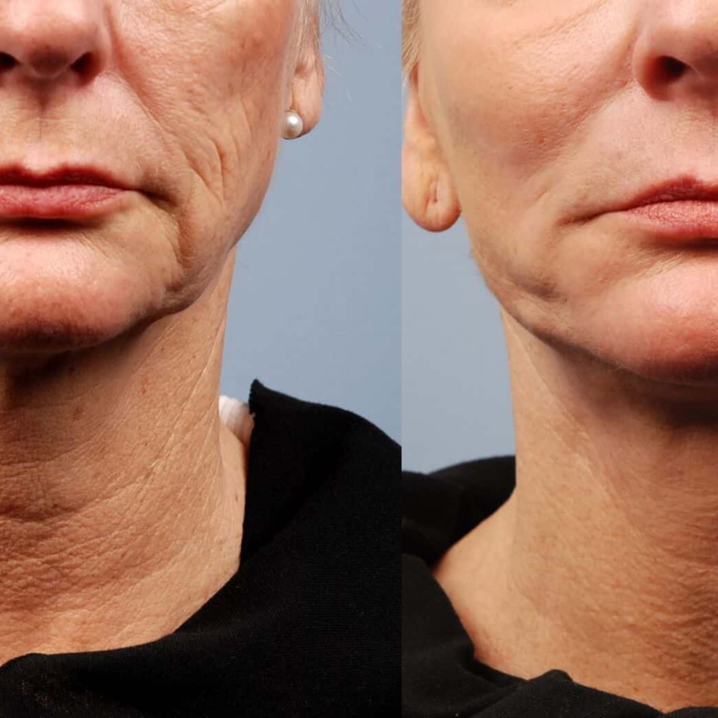 Bye-Bye Turkey Neck, Just $249! at Alora Med Spa in Boonton, NJ