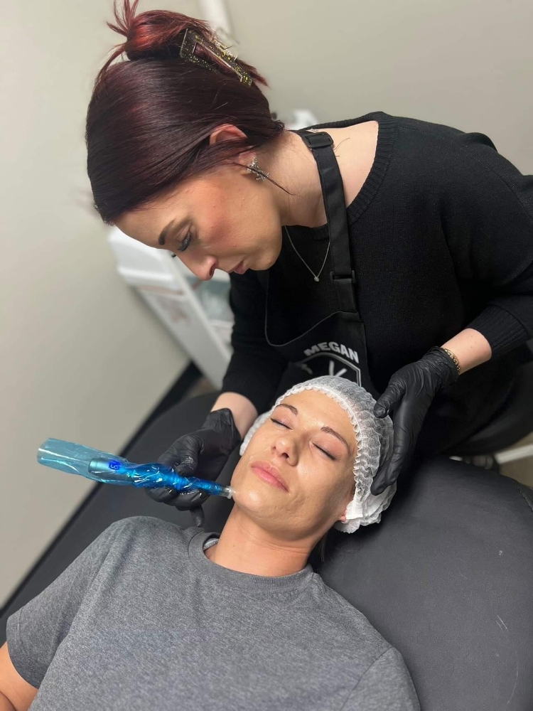 Microneedling Face