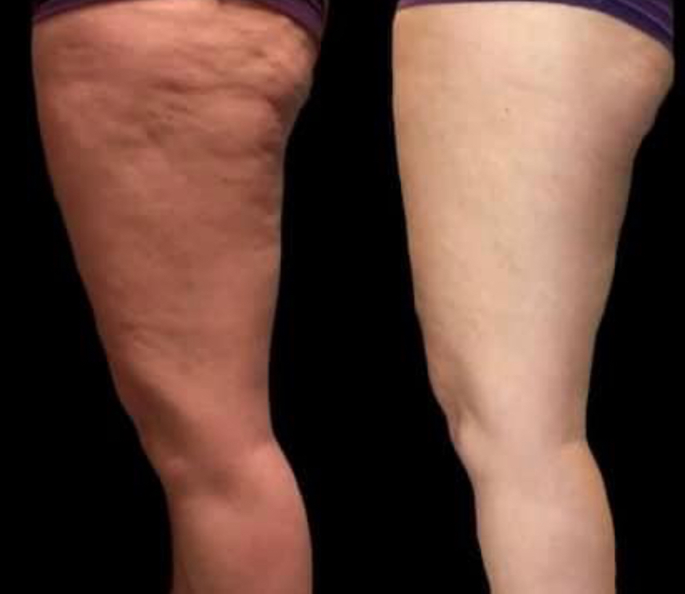 Cellulite Treatment (customized)