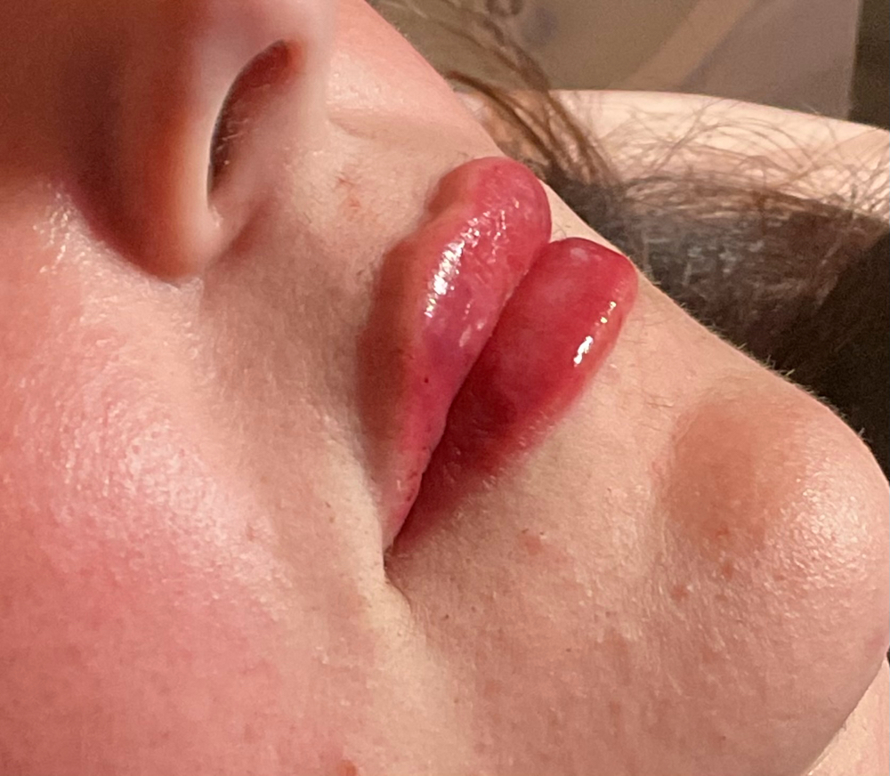 Lip Perfection Filler at Unveiled Beauty Aesthetic Studio in Converse, TX