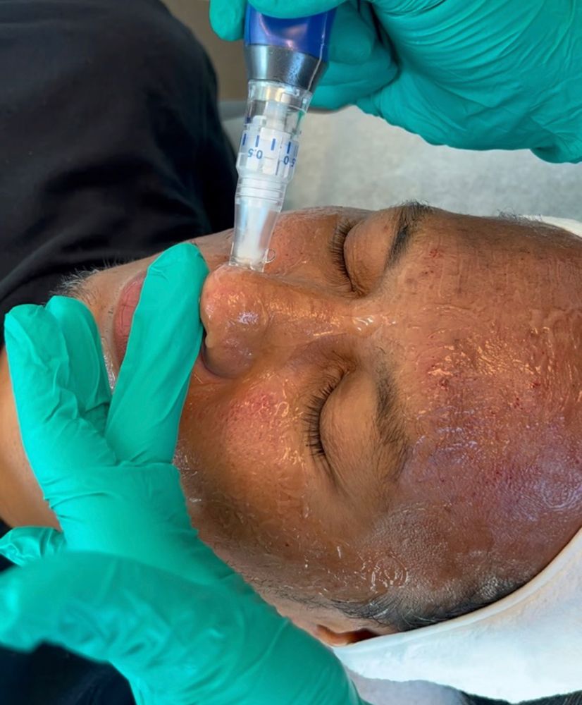 Microneedling