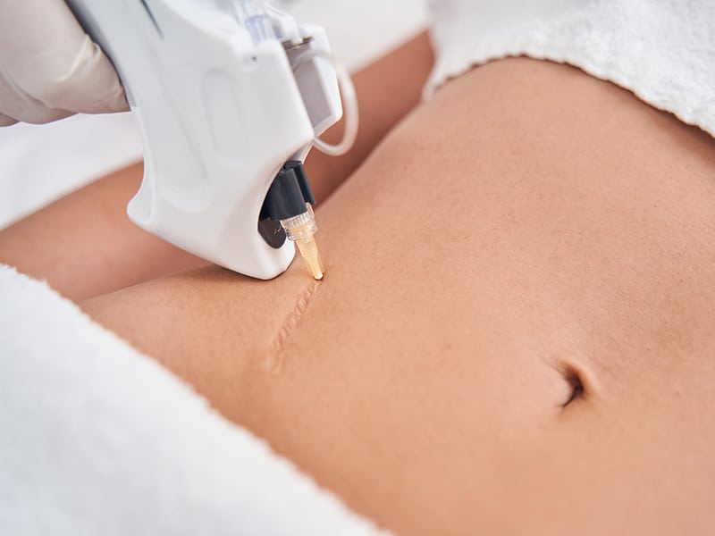 ISR Abdomen & Hips Bundle