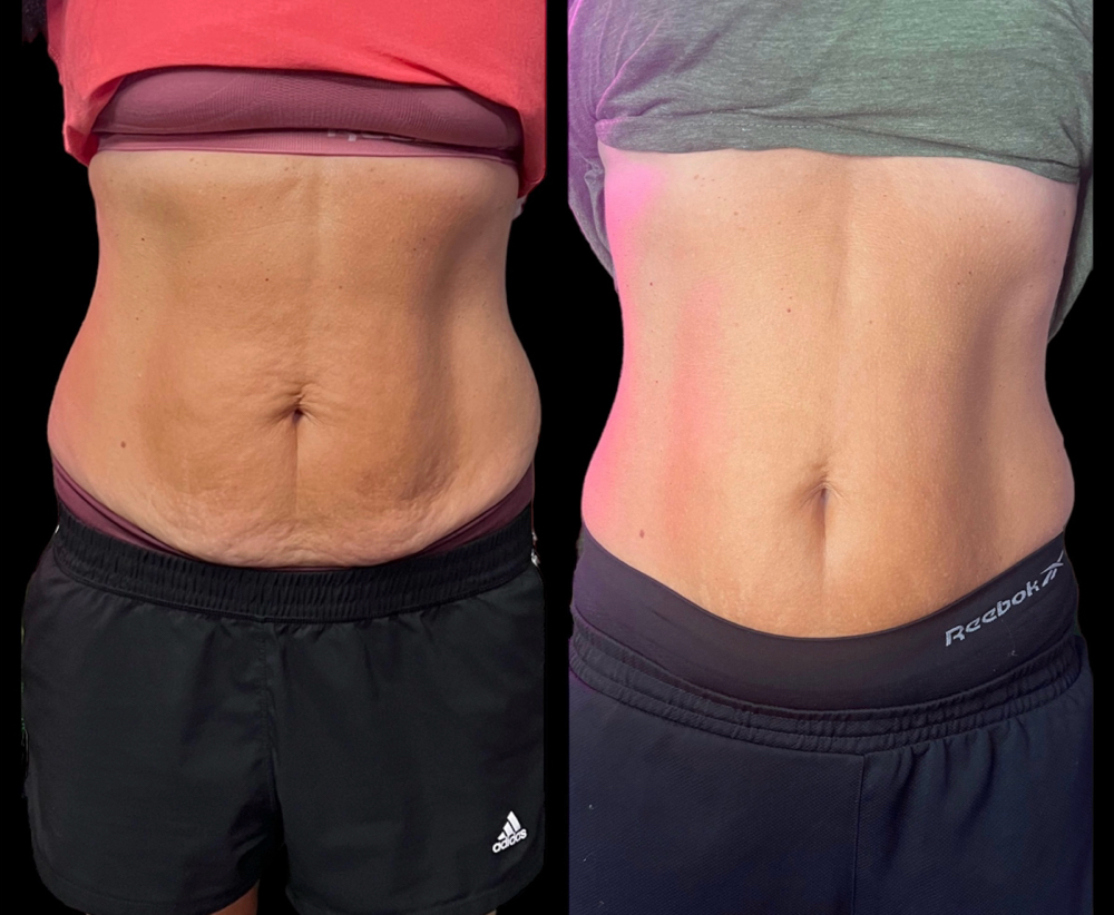 Custom skin tighten & Muscle Tone