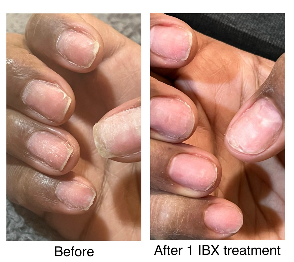 IBX Nail Strengthening Treatment