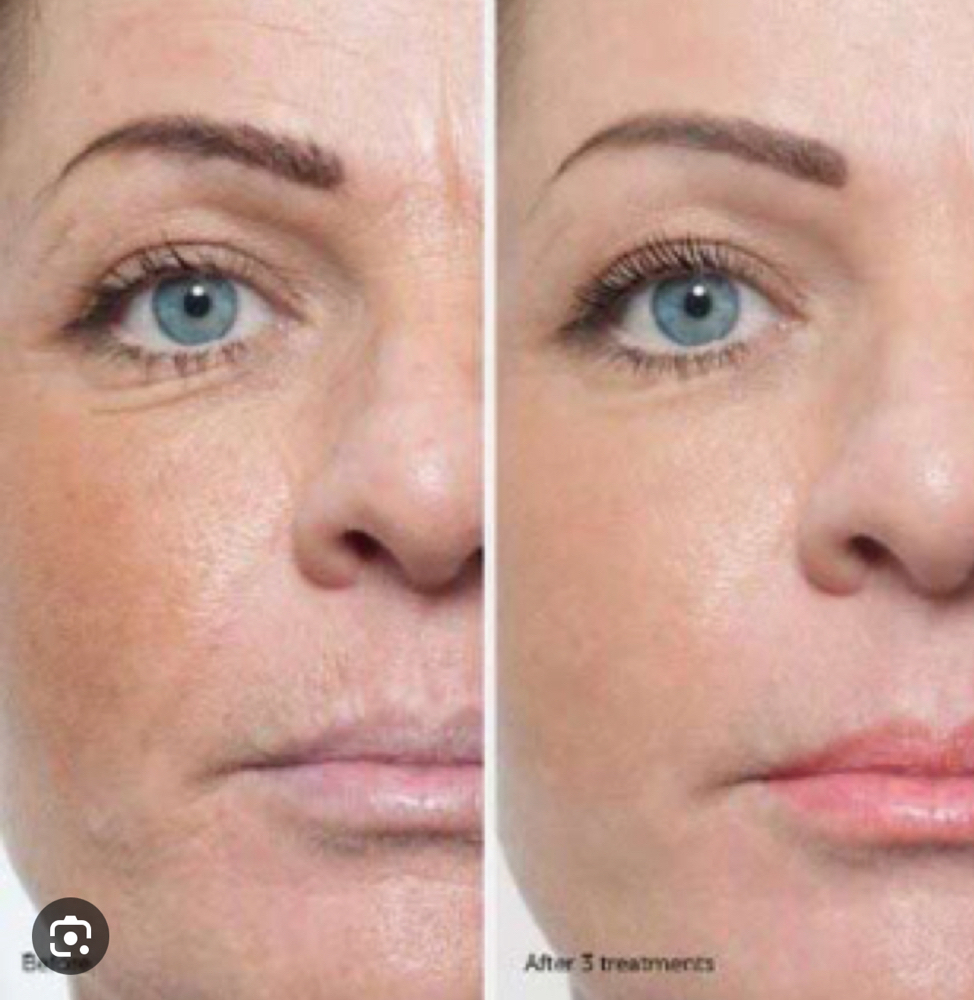 ProCell MD Stem Cell Microchannelin