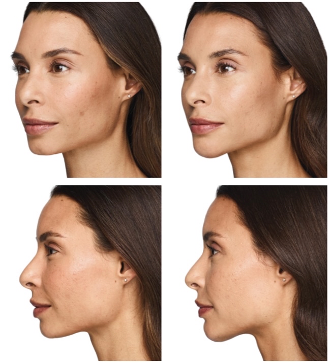 Filler- Chin/Jawline