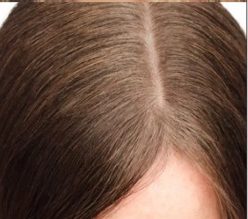 Root Retouch