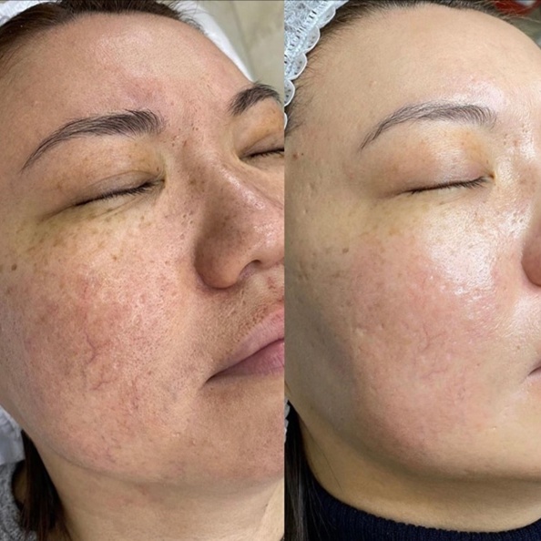 Advanced Resurfacing at Velvet Skin Aesthetics in Omak, WA