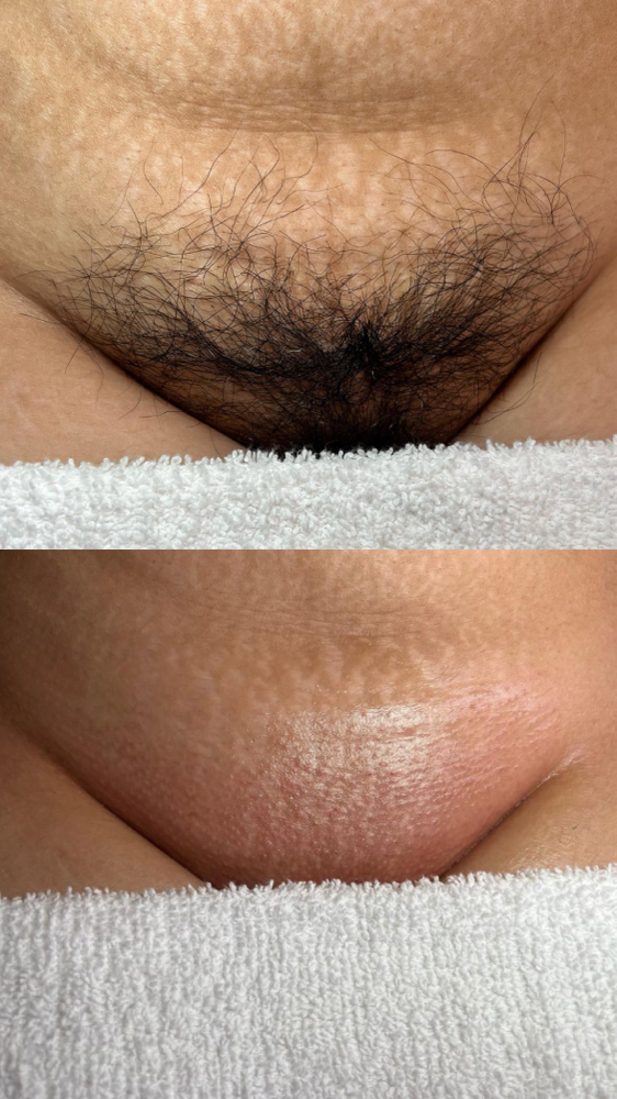 Brazilian Wax