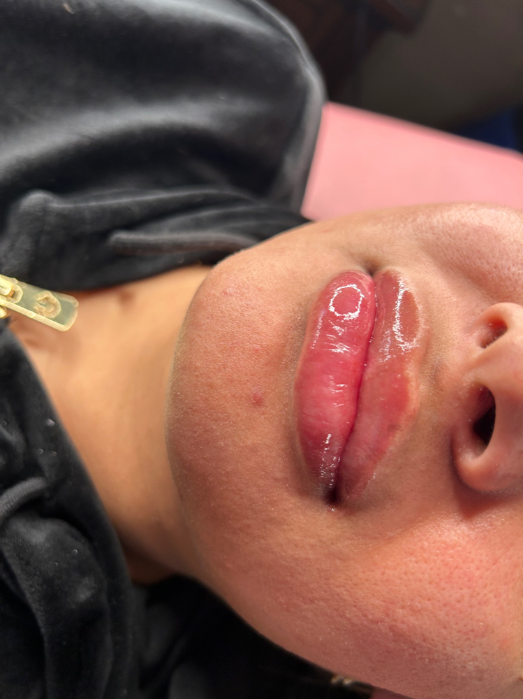 Juvederm 1ml