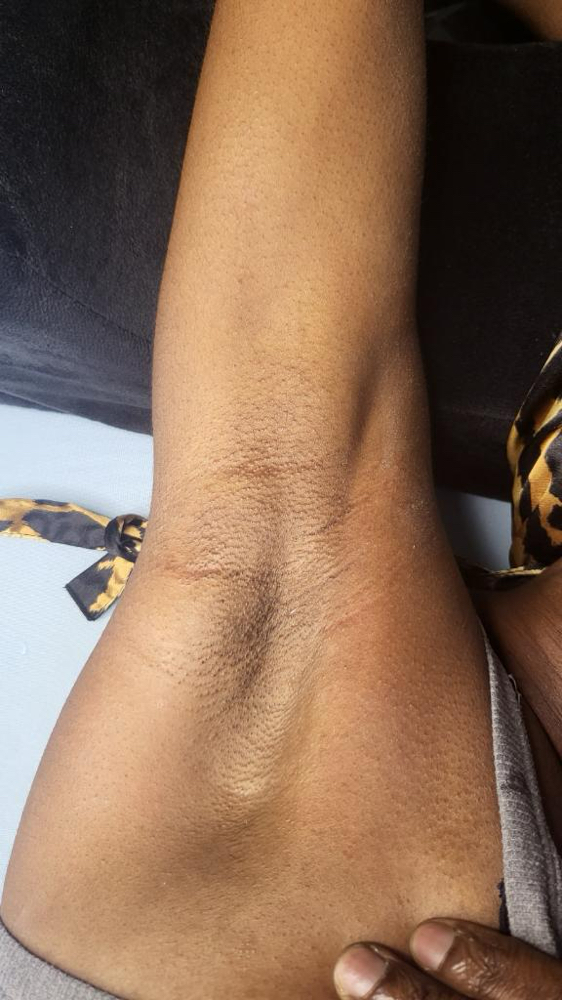 Underarm
