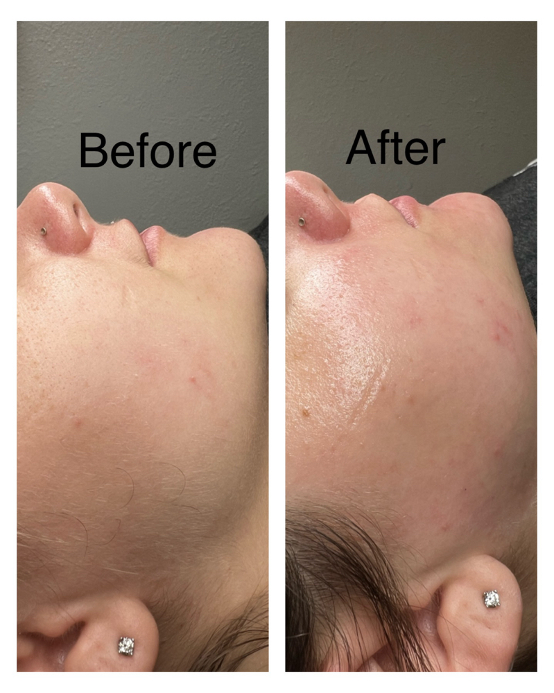 Dermaplane