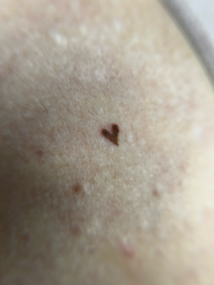 Beauty Marks/Specialty Freckles