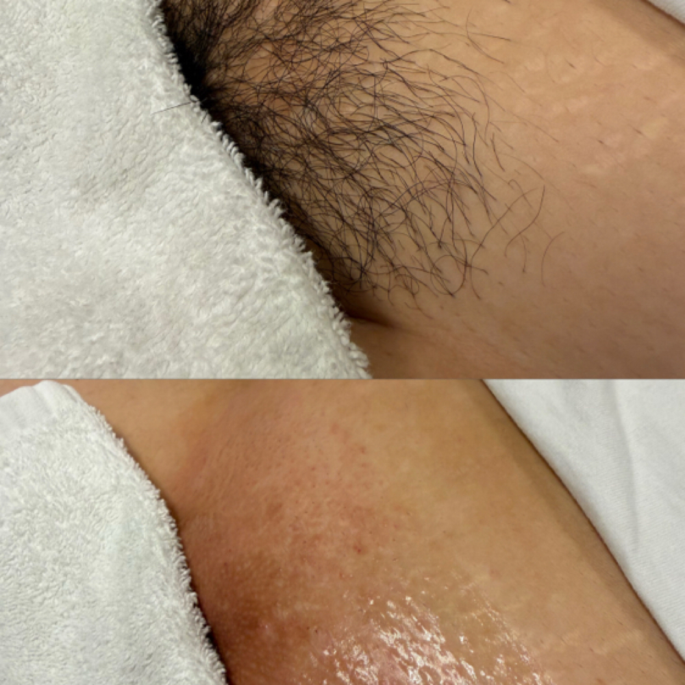 Brazilian Sugaring at Velnaira in Lakewood, CA