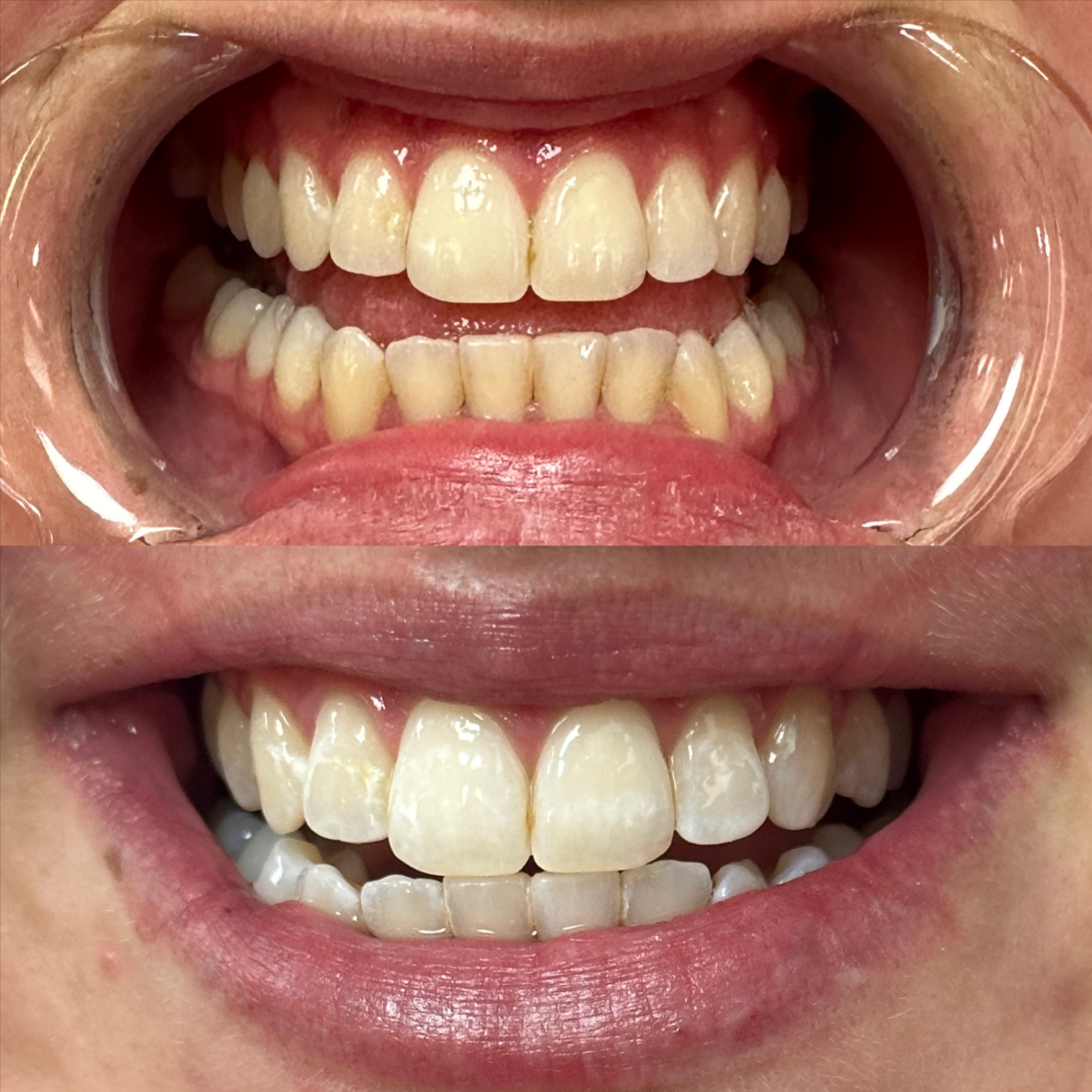 Teeth Whitening 30 min