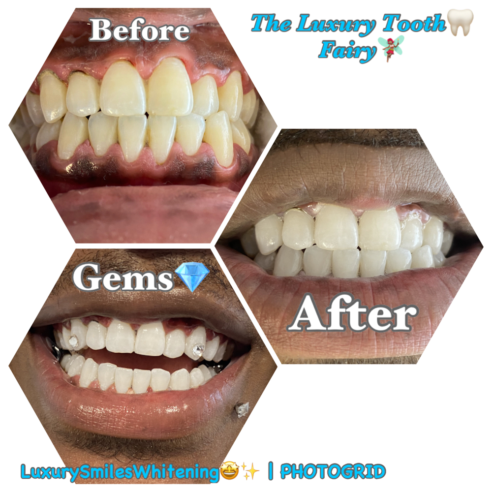 2 Tooth Gems at Luxury Smiles, Waxes & More in Dallas, TX