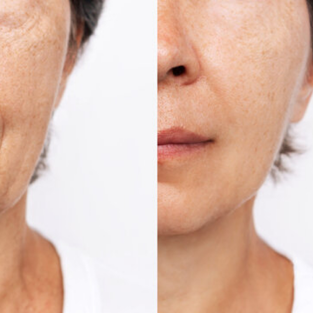 Anti Aging Facial at Refined Esthetics Co. in Chicago, IL