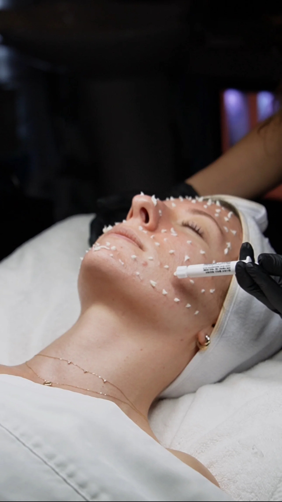 Cell Story Liquid Microneedling