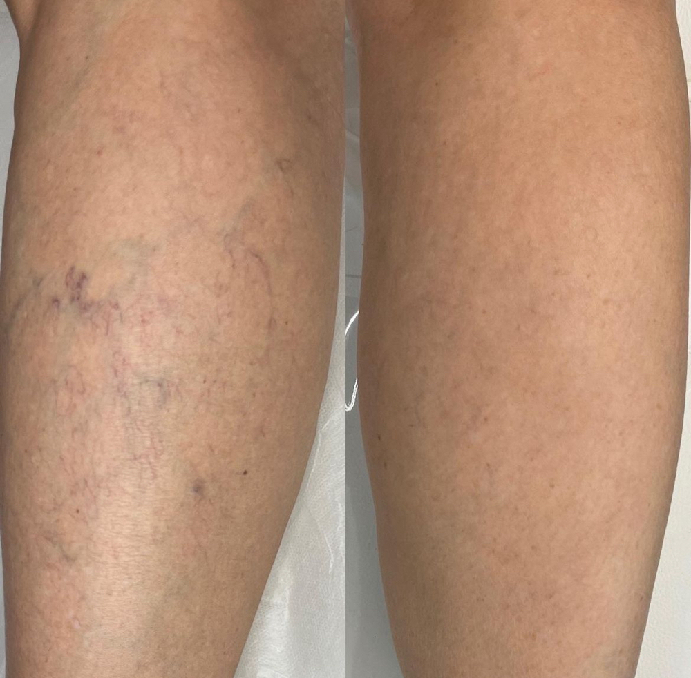 Spider Vein Laser Removal Package