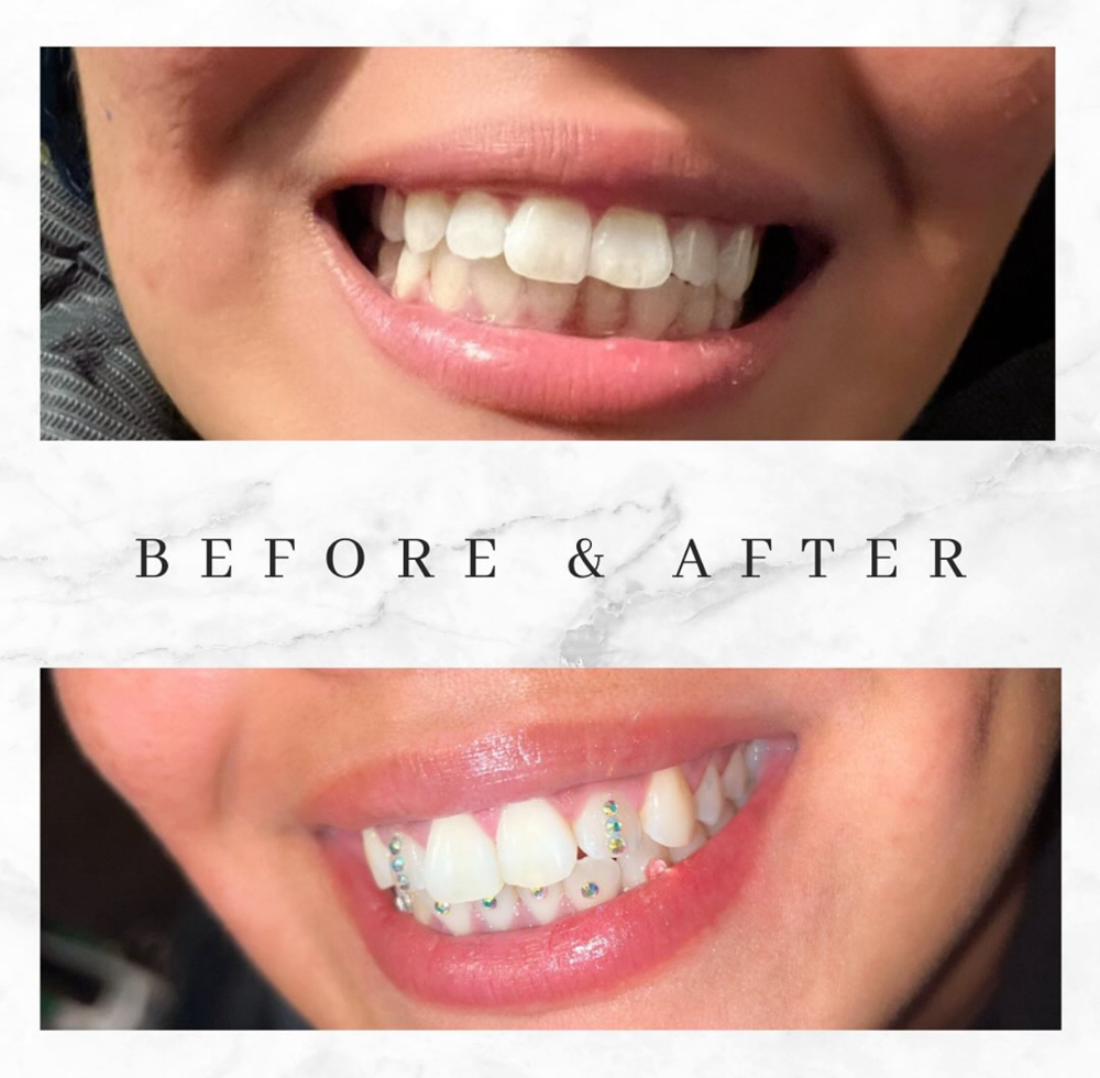 Teeth Whitening