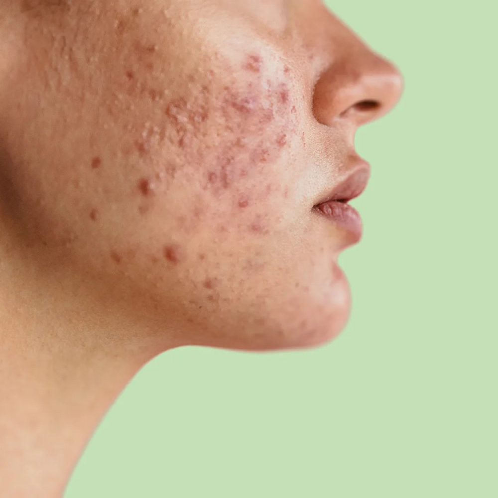 Acne Consultation & Treatment at Glam by Tam Aesthetics in Madison, WI