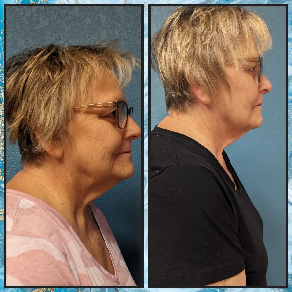 Skin Tightening