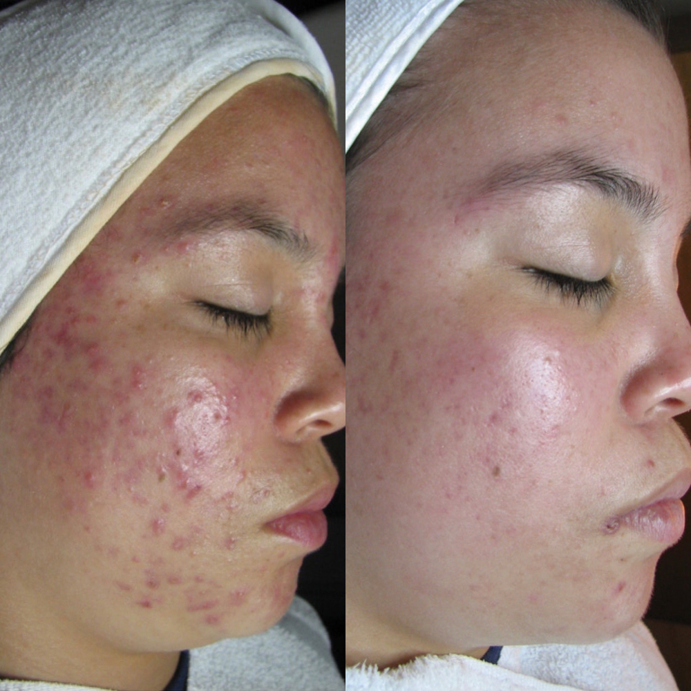 Acne Consultation+ Treatment