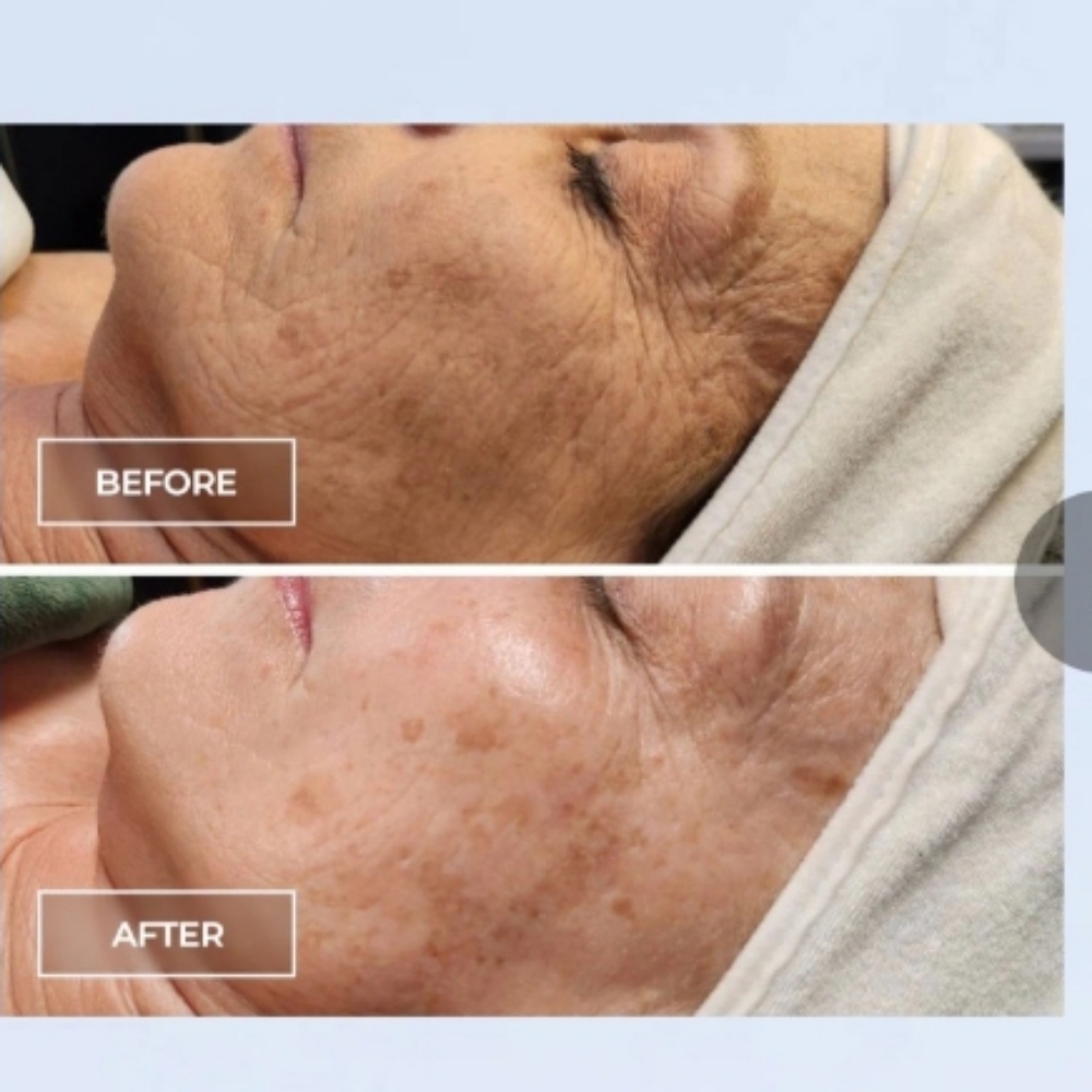 Circadia Switch Treatment at Bare Beauty Rituals in Vacaville, CA
