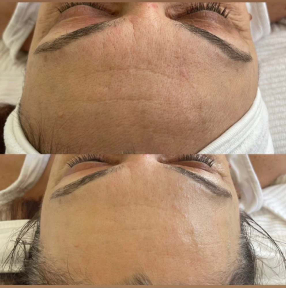 Platinum Skin Chemical Peel at The Full Edit Aesthetic Studio in Florence, AL